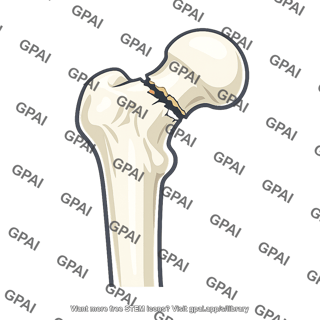 Femur neck fractured