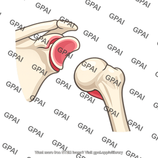 Shoulder joint dislocated