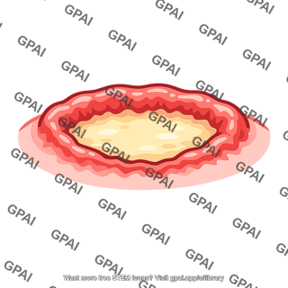 Ulceration
