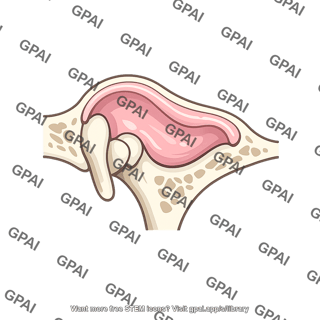 Epitympanic recess