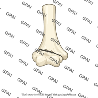 Supracondylar fracture humerus