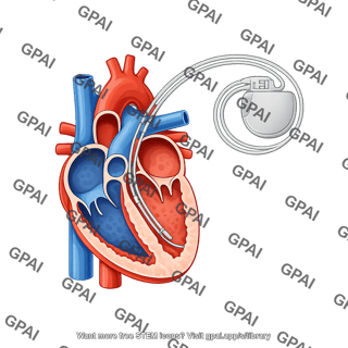 Heart human cross section with icd implant