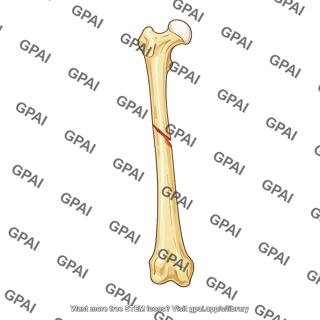 Femur anterior fracture