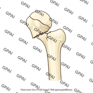Surgical neck of humerus fractured