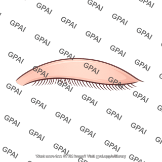 Eyelid upper