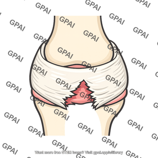 Joint capsule disrupted