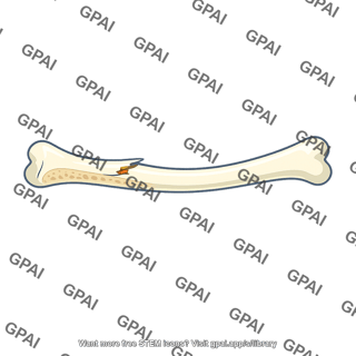 Greenstick fracture