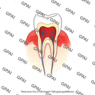 Tooth premolar gingivitis tooth only
