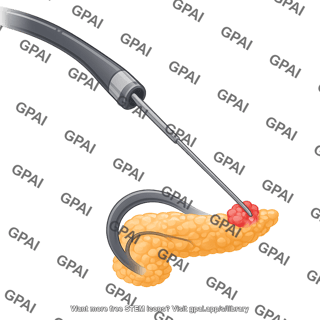 Endoscopic ultrasound guided fine needle aspiration eus fna with pancreas