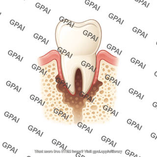 Tooth premolar bone severe bone loss