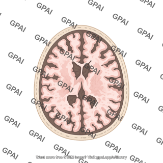 Brain atrophy