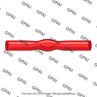 Artery aneurysm