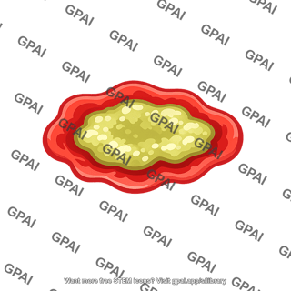 Abscess illustration