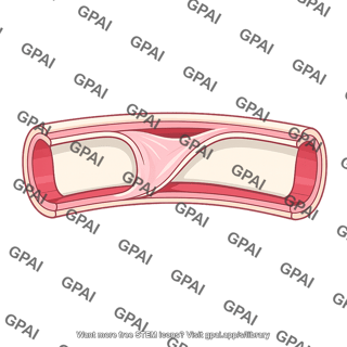 Intimal flap