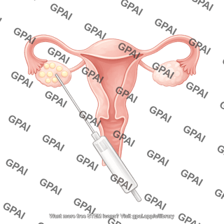 Ivf egg retrieval