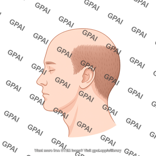 Male balding stage 3 lateral