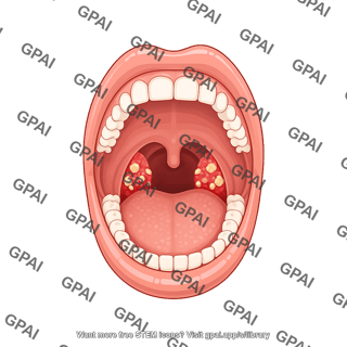 Mouth open tonsillitis
