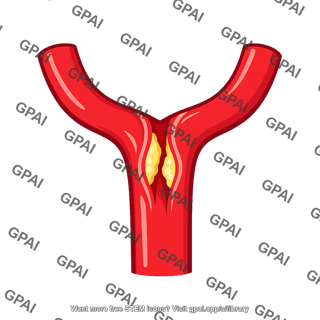 Common iliac artery obstructed