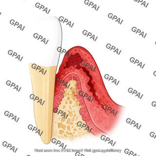 Gingival epithelium periodontal disease