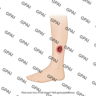 Lower leg human lateral with chronic wound