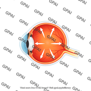 Eye sagittal glaucoma