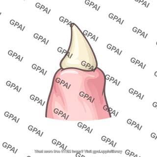 Corniculate cartilage