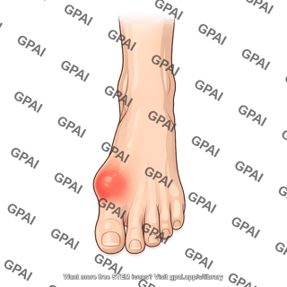 Foot anterior with swollen joint