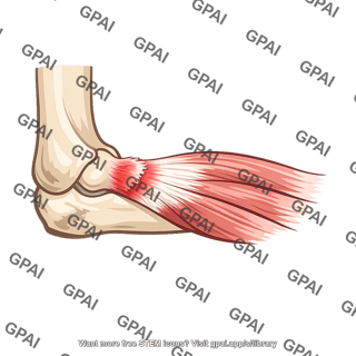 Lateral epicondylitis
