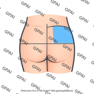 Gluteal region upper outer quadrant