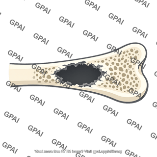 Bone lesion lytic