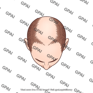 Male balding stage 2 superior 591