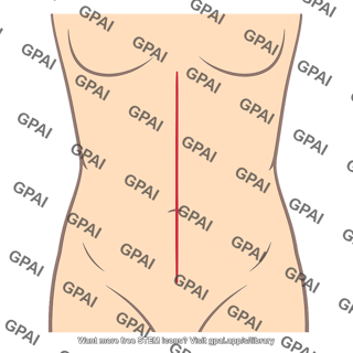 Midline abdominal incision