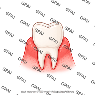 Tooth premolar gums gingivitis