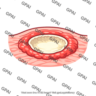 Peptic ulcer