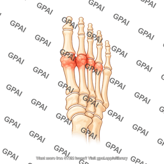 Foot bones dorsal arthritic midfoot