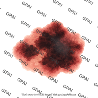 Superficial spreading melanoma skin cancer