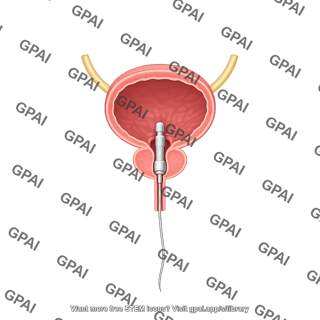 Bladder human male with prosthetic urethra