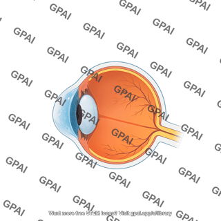 Eye corneal edema sagittal