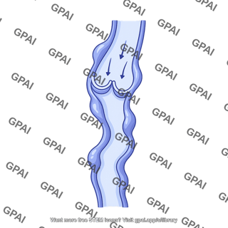 Venous valve varicose