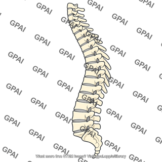 Kyphosis