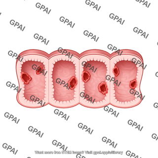 Large intestine cross section with ulcers human
