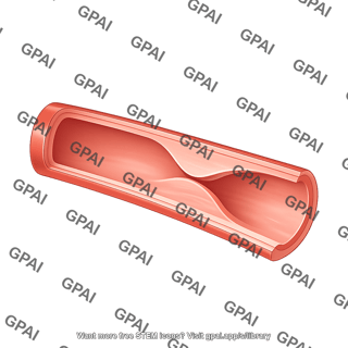 Blood vessel cut artery dissection type 1