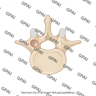 Lumbar vertebra with laminotomy l5 superior