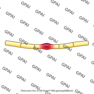 Injured nerve