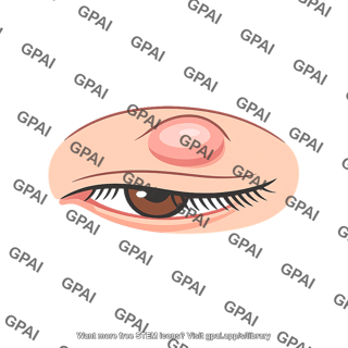 Chalazion