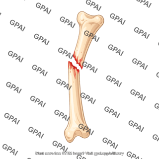 Tibial shaft fracture complete distal half