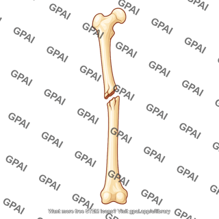 Femur anterior fracture middle