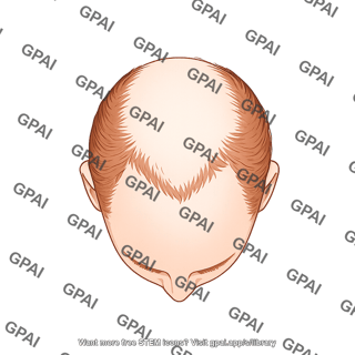 Male balding stage 3 superior 330
