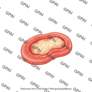 Ulcer shape 1