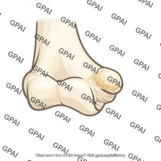 Lateral epicondyle